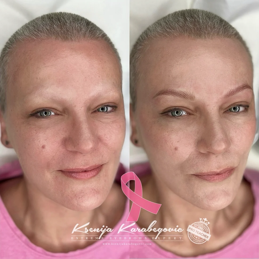 Eyebrow restoration before and after for cancer, alopecia and chemotherapy-related brow loss